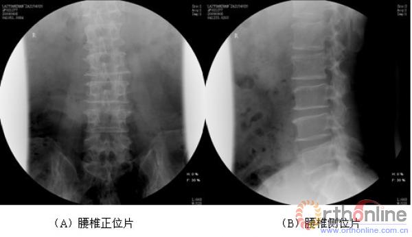 腰椎生理曲度变直图片
