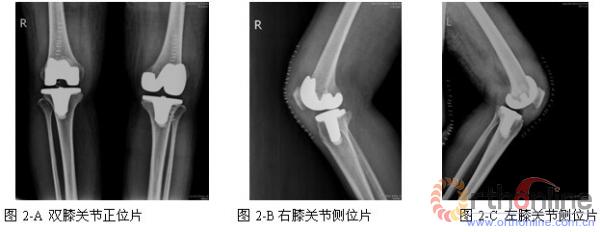 双膝关节置换围手术期抗凝致椎管内血肿1例 | 骨科在线