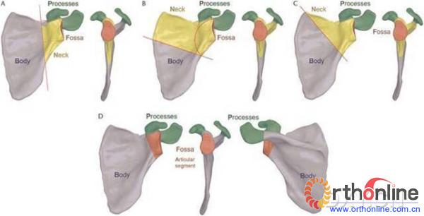 肩胛骨骨折分型(肩胛盂和体部)的kappa值和病例数表3外科医生单独使用