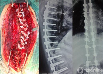 个性化3D打印导航模板在骨科手术的应用研究 | 骨科在线