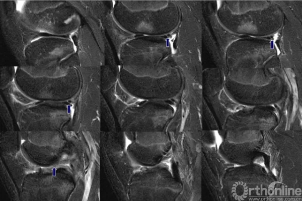 半月板撕裂的分类及MR的诊断要点