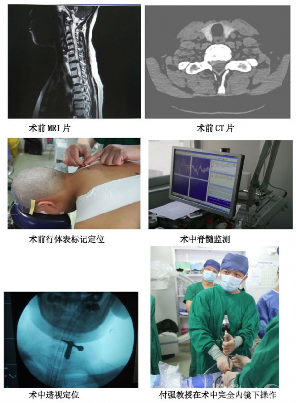 颈椎病治疗的新常态 ——微创经皮脊柱内镜技术