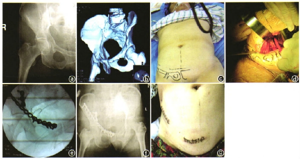 交通事故导致左髋臼骨折,四根肋骨折,左眼闭合