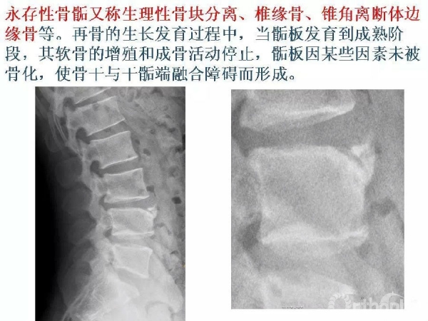 鉴别要点籽骨副骨永存性骨骺以及撕脱性骨折