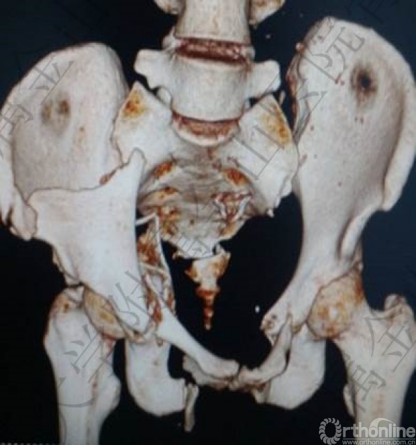 病例汇报--不稳定骨盆骨折抢救与治疗 | 骨科在