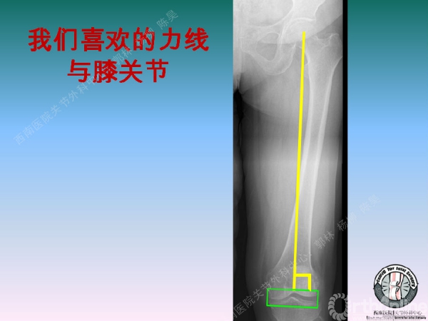 股骨远端力线外翻角●mldfa(mechanical lateral distal femoral