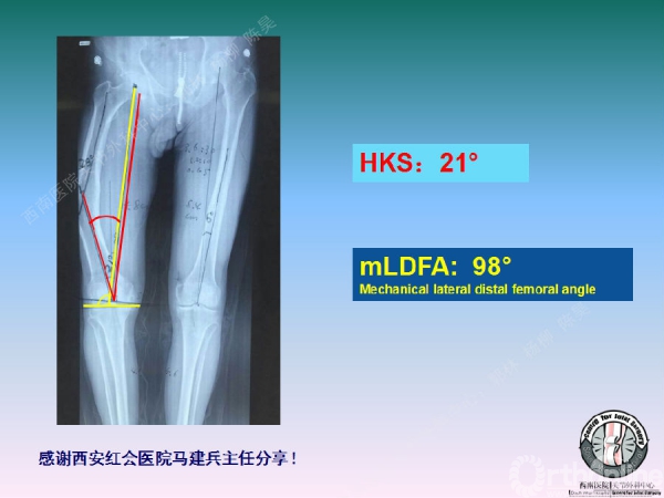 股骨髁上骨折后关节外畸形tka术中股骨内髁滑移截骨