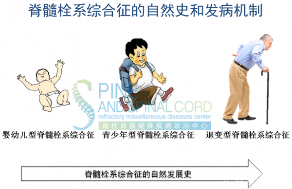 脊髓栓系综合征的发病分期和脊柱外科治疗策略