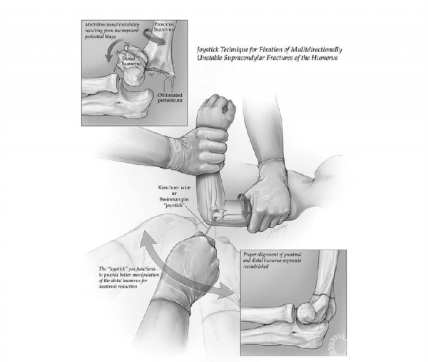操纵杆技术治疗儿童多向不稳定肱骨髁上骨折的