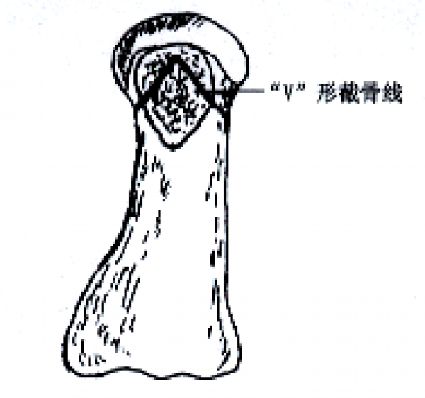 1austin手术方式--b 矢状面v形截骨