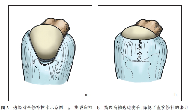肩袖修补术后再断裂原因分析