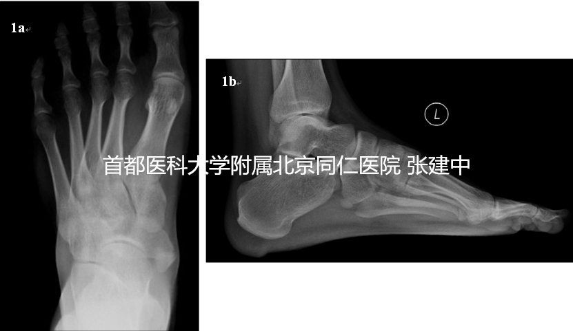患足负重侧位x线,示副舟骨存在及足弓乔榭 
