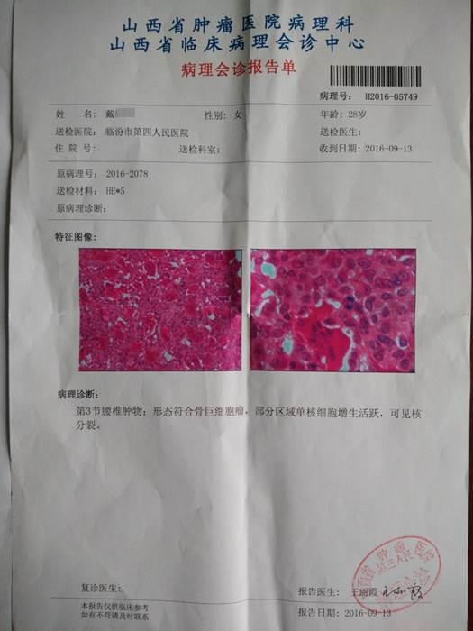 术后医院行病理科汇报考虑为"骨巨细胞瘤",为明确诊断,请山大