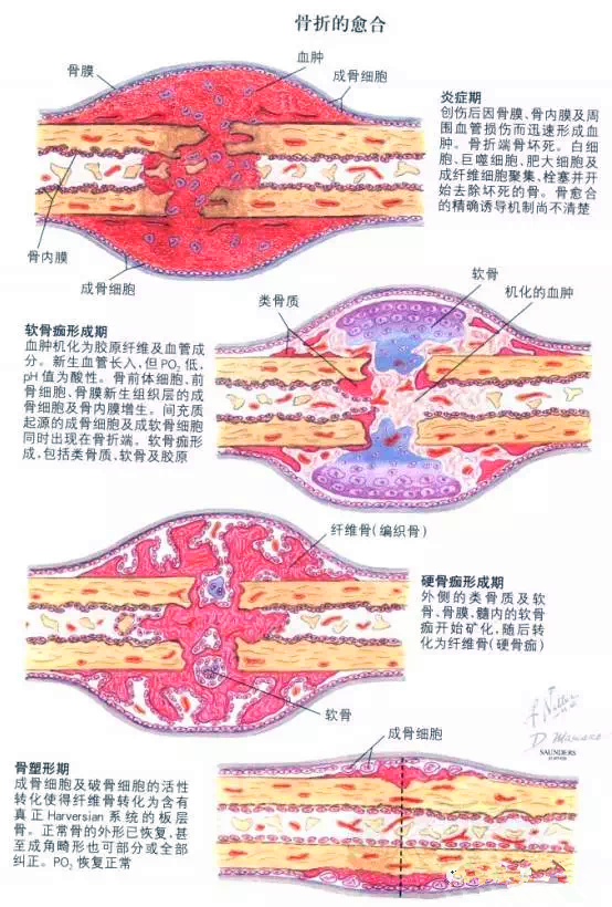 一图带您轻松了解骨折愈合