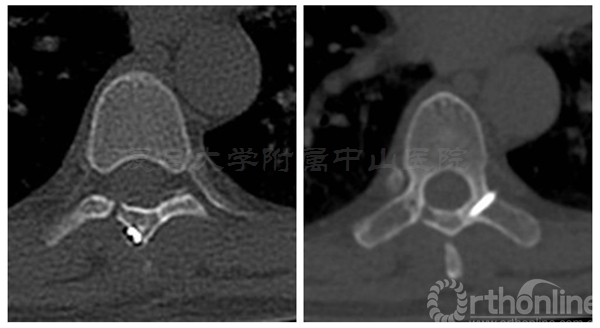 复旦大学附属中山医院骨科邀您换个角度看微创