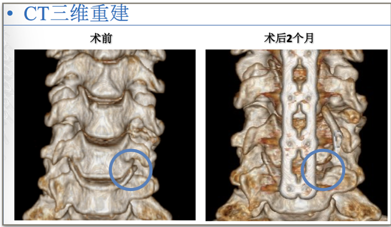 钩椎关节退变容易被脊柱外科医师忽视的结构