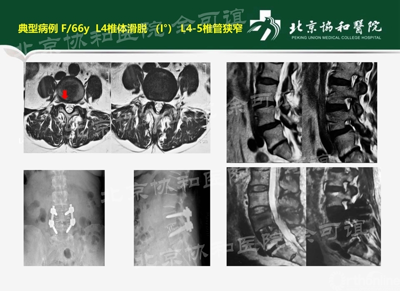 文献精解 Olif的学习曲线与早期并发症 骨科在线