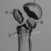 肱骨近端四部 ...