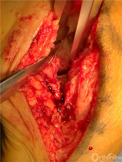 烟台山医院完成首例足charcot关节病的手术附病例