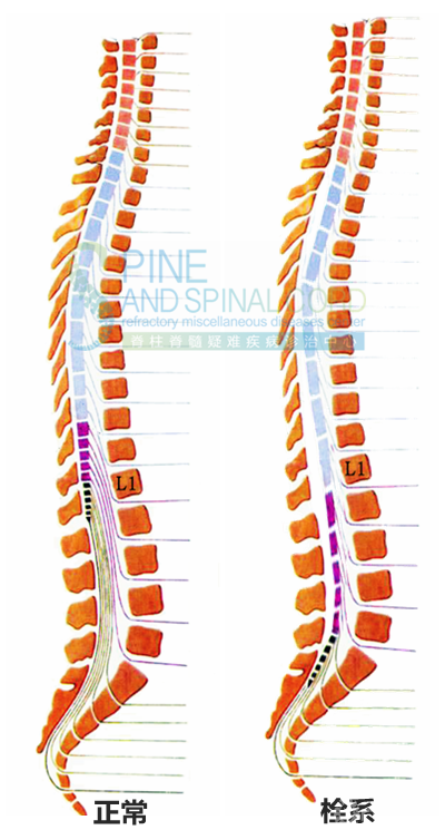 其脊髓和神经根均受到轴向牵拉;由于hofmann韧带的存在,仅切断终丝或