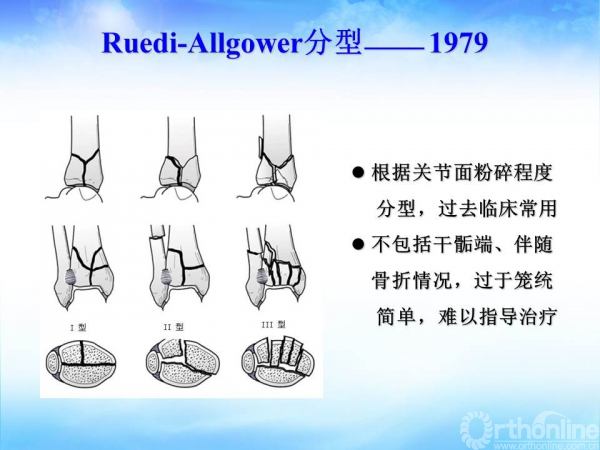 pilon骨折分型与手术策略