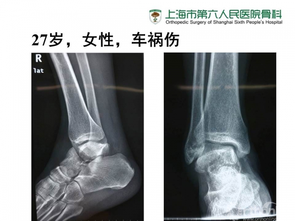 距骨颈骨折的诊疗常规