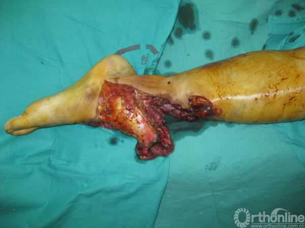 下肢gustiloiiib型和iiic型骨折的保肢治疗及疗效评价