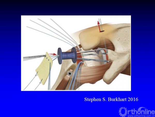 高绪仁美国牛仔肩关节镜专家stephensburkhart是怎么进行上关节囊重建