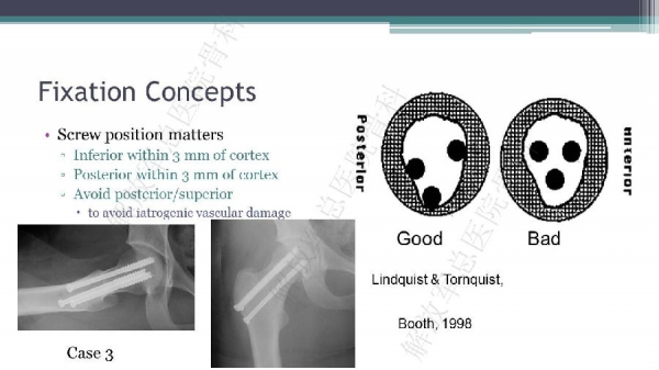 股骨颈骨折内固定手术技术