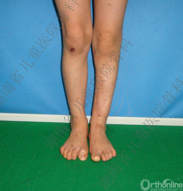 儿童小腿弯曲畸形反复骨折不愈合  骨科专家给您解答