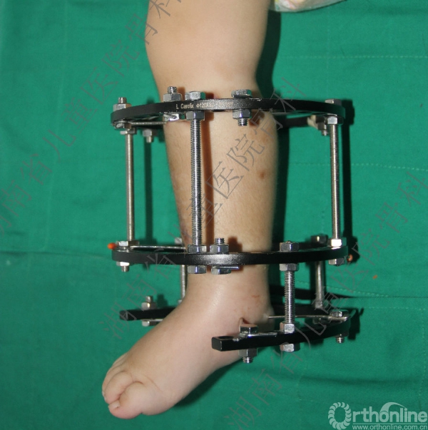 儿童小腿弯曲畸形反复骨折不愈合骨科专家给您解答