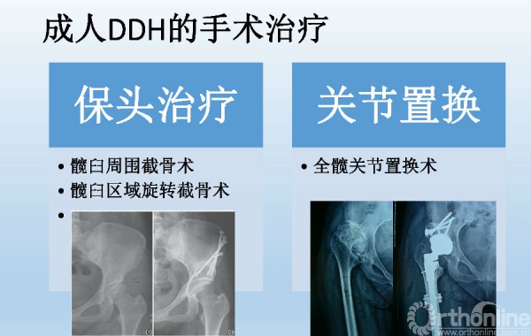 擅長：成人發育性髖關節發育不良、DDH人工關節置換術、運動醫學。專家預約掛號，只需要您的一個電話的簡單介紹
