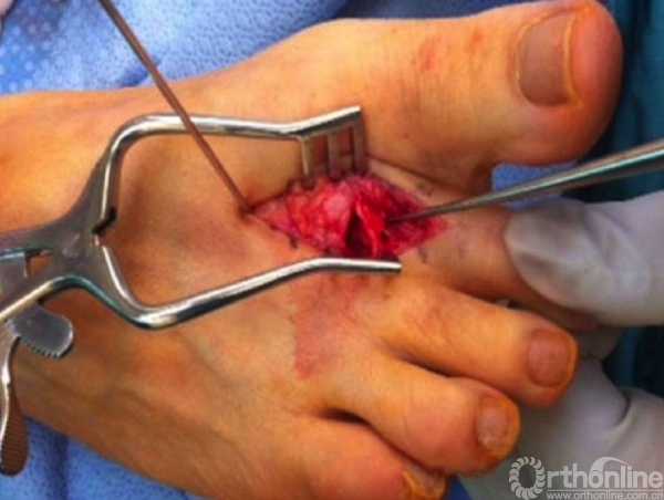 以半径较小的的弧形针直接缝合图1:背侧入路,行weil截骨背侧入路,weil