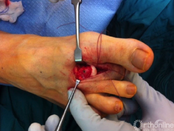 3mm皮质骨螺钉固定weil截骨61 以0-vicryl修复侧副韧带61 完成