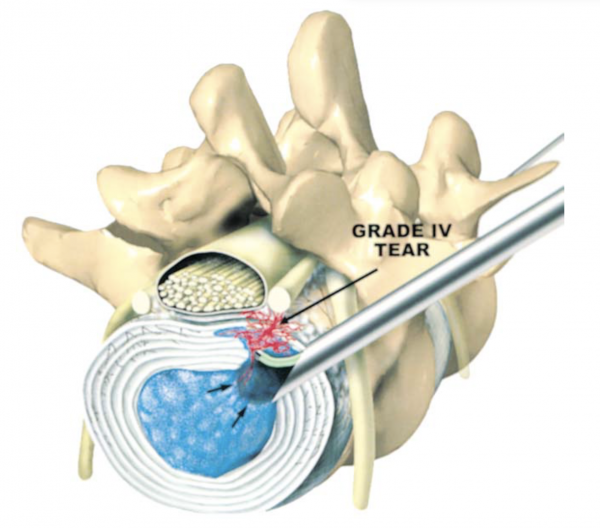 椎间孔镜治疗盘源性腰痛的技巧与策略