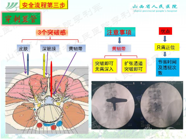椎间孔镜椎板间入路安全快速流程之全内镜旋转破黄7步法