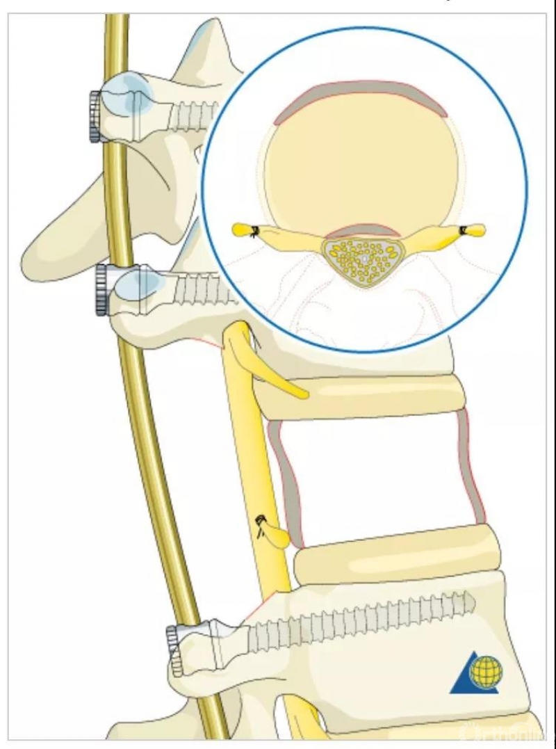 图解脊柱6级截骨术