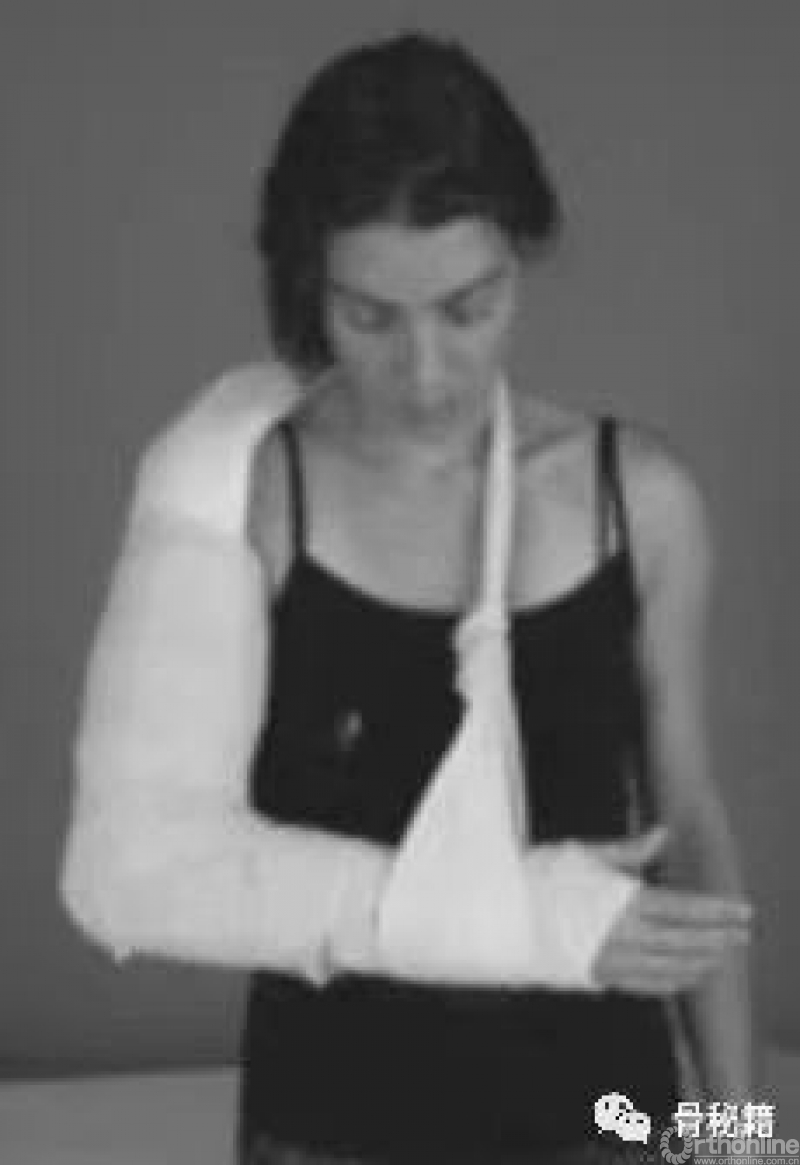 石膏固定是个很讲究事儿