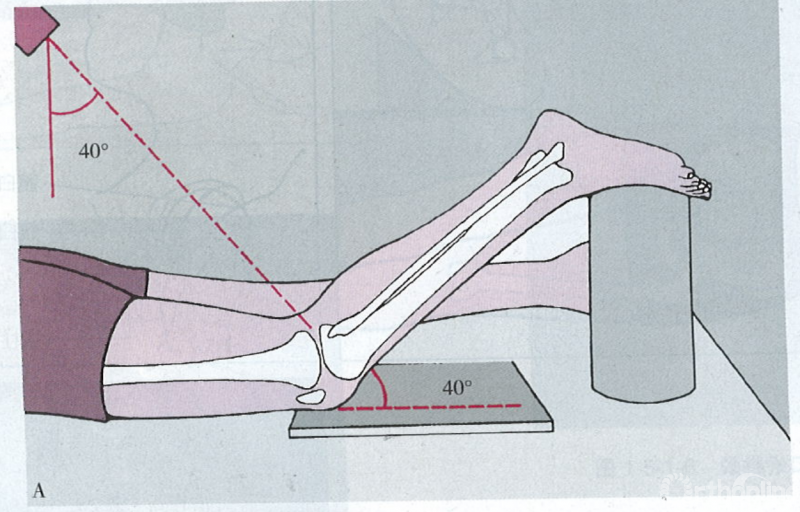 (5)屈膝位:用以了解股骨髁间窝病变.