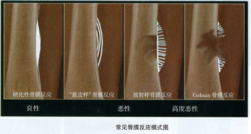 骨膜受刺激后骨膜增生,形成骨膜新生骨称为骨膜反应,x线表现多种多样