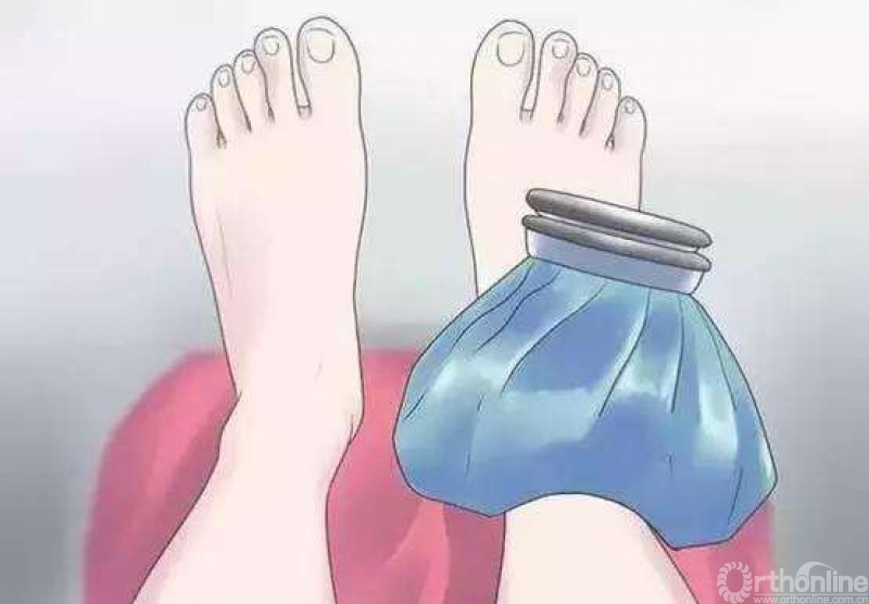 冰敷的消肿可有效减少张力性水泡的发生,为骨折治疗赢得宝贵手术时机.