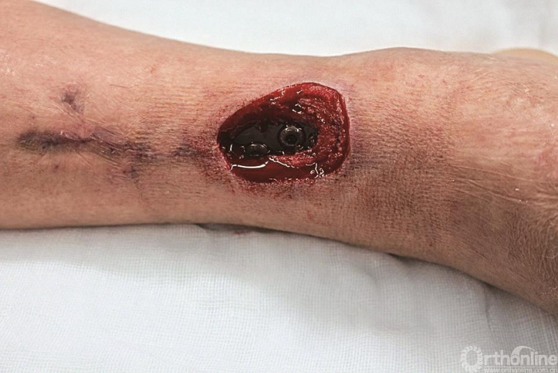 病例赏析胫腓骨骨折术后切口不愈合伴接骨板外露
