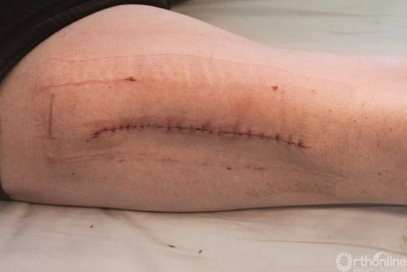 病例赏析胫腓骨骨折术后切口不愈合伴接骨板外露