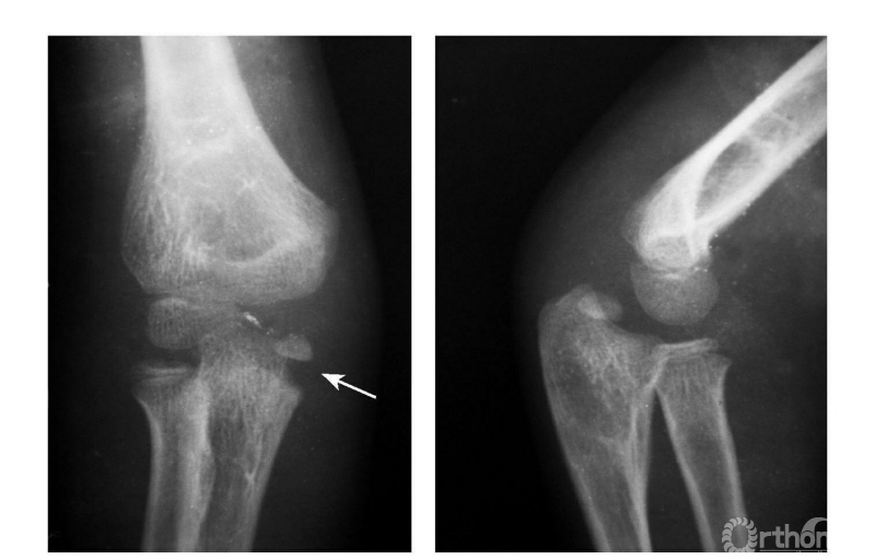 图8Ⅳ度损伤:例1:肘关节外后脱位并肱骨内上髁撕脱骨折,骨块移向尺肱