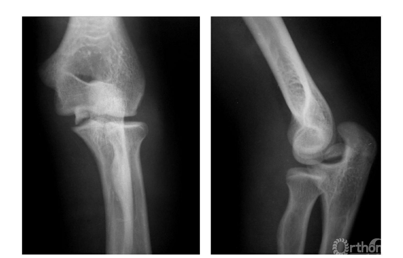 肱骨内上髁骨折图片图片