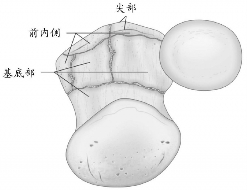 图8 冠状突这分型(odriscoll分型)小结本文就冠状突骨折的解剖,临床