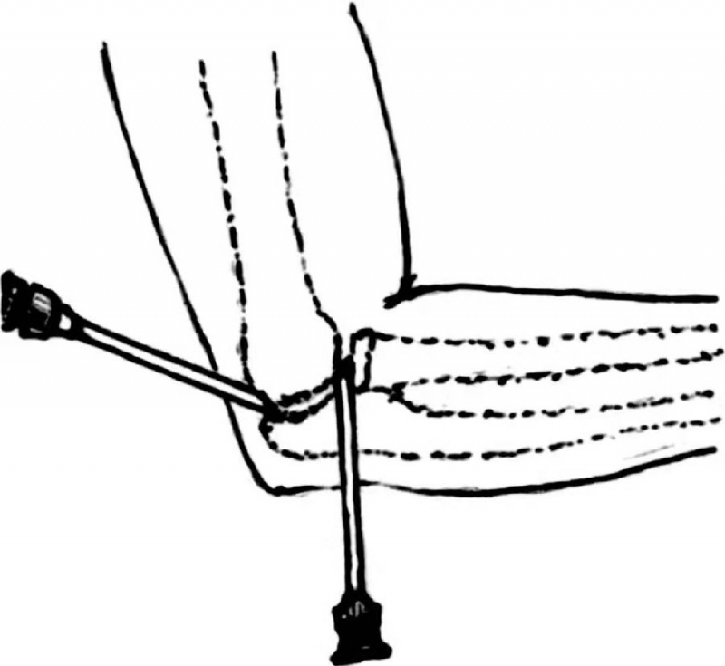 肘关节穿刺术肘关节屈曲90°,在桡骨小头近侧,于其后外方向前下进针