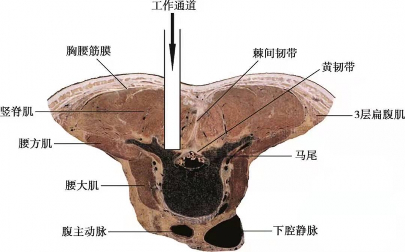 椎旁间隙解剖图片图片