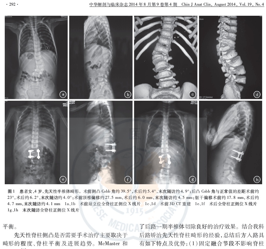 后路半椎体切除治疗先天性半椎体畸形
