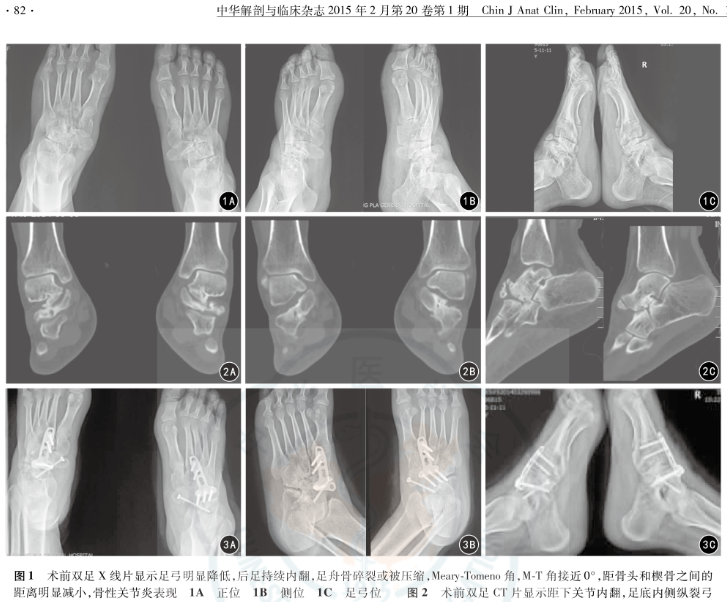 距舟舟楔关节融合术治疗双侧足舟骨坏死1例